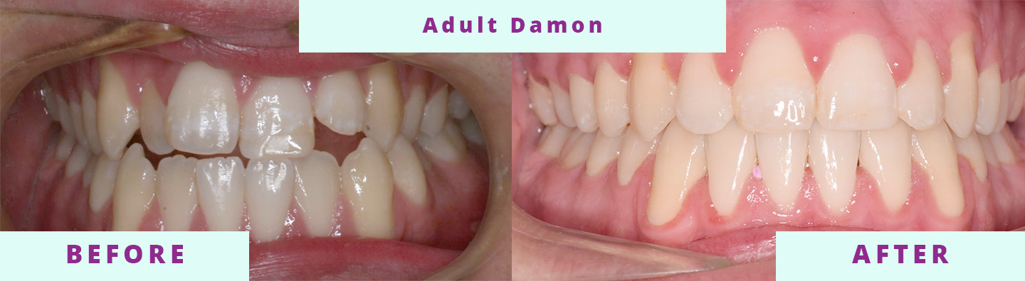 Invisalign Before & After