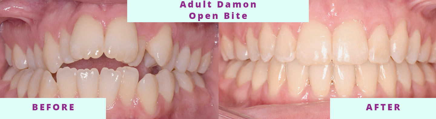 Invisalign Before & After