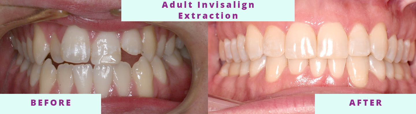 Invisalign Before & After