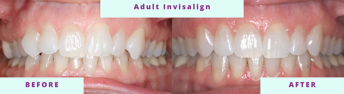 Invisalign Before & After