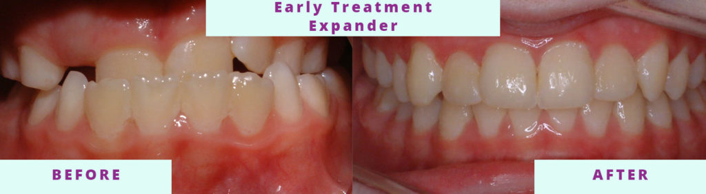 Early Treatment Expander Before and After