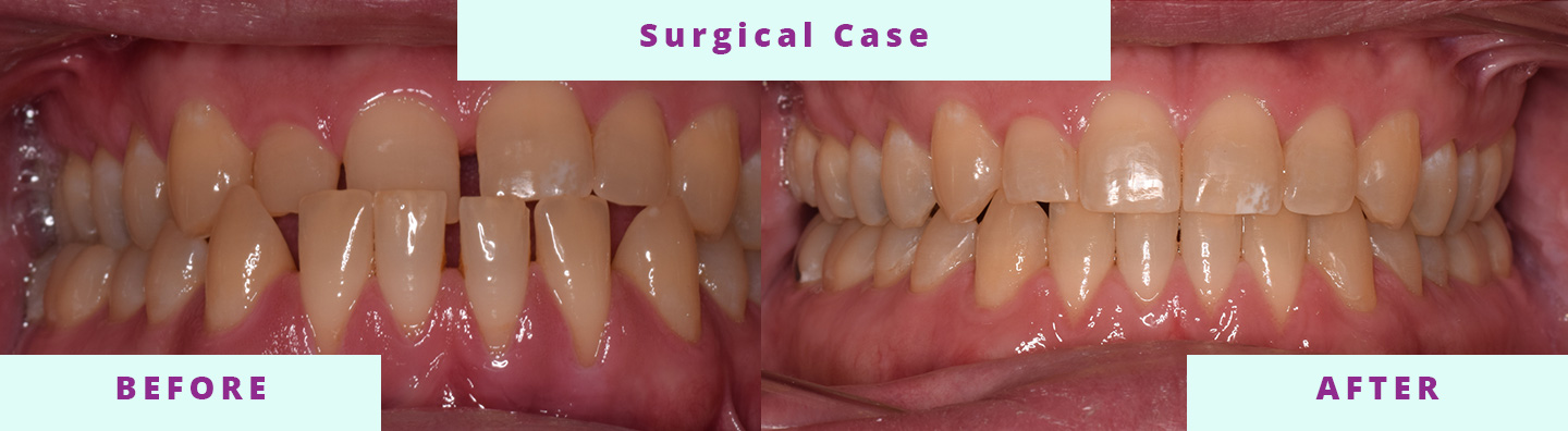 Surgical Before and After