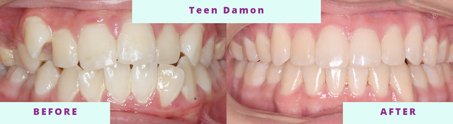 Invisalign Before & After