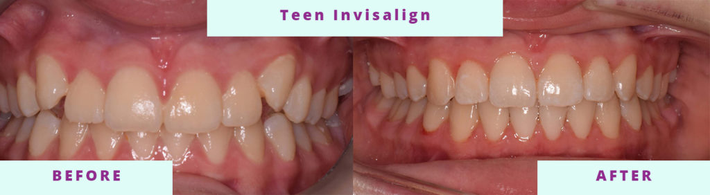 Teen Invisalign Before and After