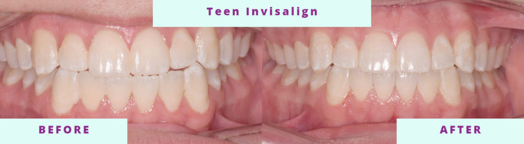 Teen Before and After
